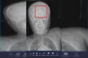 Raio X da cabeça do menino
